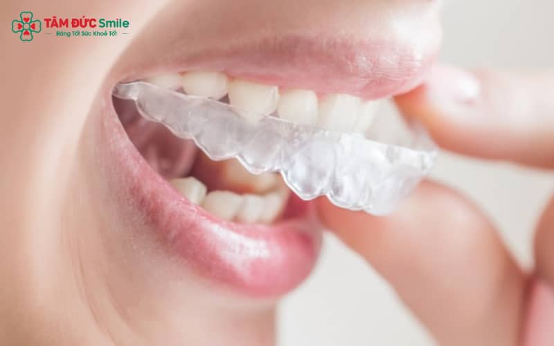 Sau tháo mắc cài, hàm duy trì có nhiệm vụ duy trì kết quả và phòng ngừa xô lệch răng