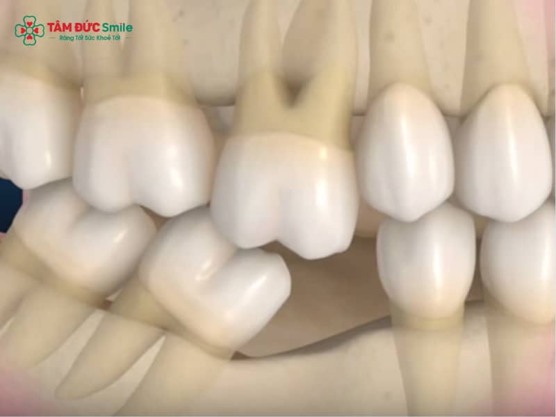 Nguyên nhân răng chạy lại sau khi tháo niềng và cách khắc phục hiệu quả