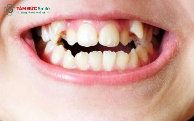 Răng chó, là 4 chiếc răng nằm ở vị trí số 3 tính từ răng cửa giữa