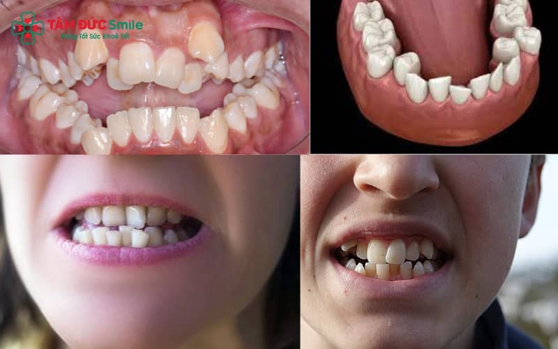 Răng mọc chen chúc là tình trạng các răng không thẳng hàng, có thể chồng chéo, xoay lệch hoặc nghiêng trên cung hàm