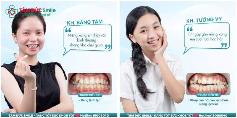 Thời gian Abc888k vip truy cập nhanh răng chen chúc trung bình kéo dài 18 – 30 tháng