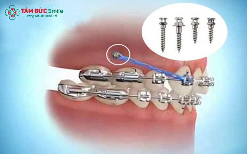 Cắm minivis giải pháp tăng hiệu quả di Link Vào Abc8.com Đăng Ký Tặng 88K trong các ca chen chúc phức tạp.