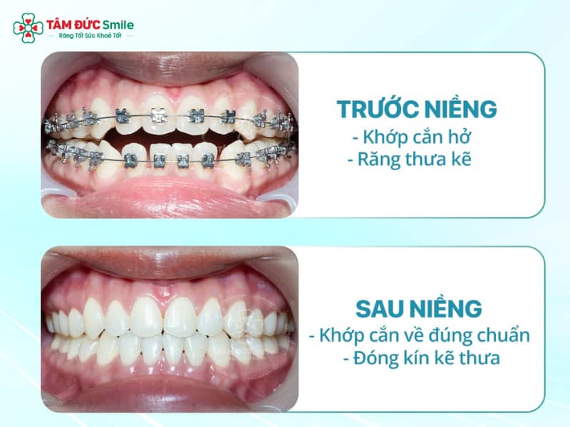 Sự kết hợp giữa công nghệ tiên tiến và tình trạng răng cá nhân tối ưu hóa tốc độ niềng
