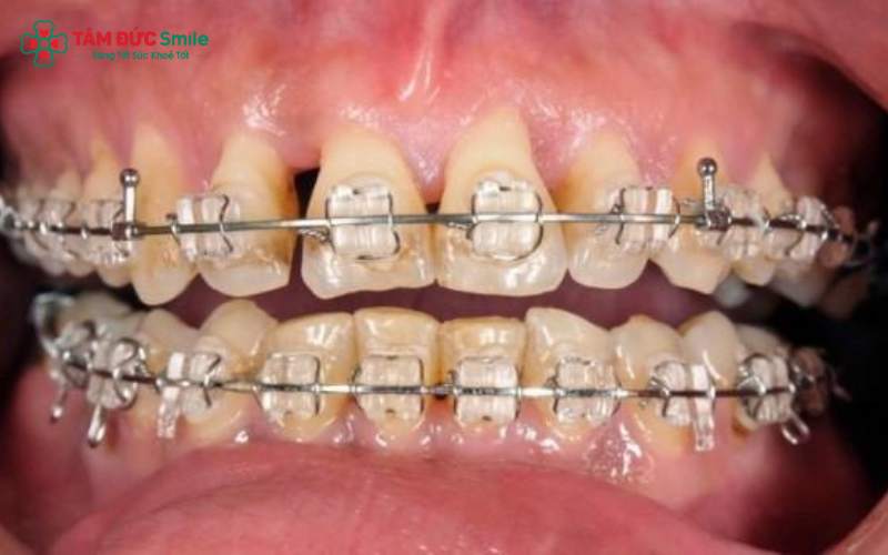 ABC8 được thành lập vào năm 2011 hoạt động đến hiện tại sai kỹ thuật có thể gây viêm và tụt nướu