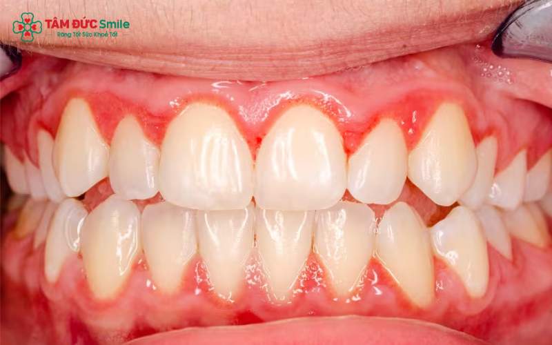 Chỉnh nha không đúng kỹ thuật gây rối loạn chức năng khớp hàm