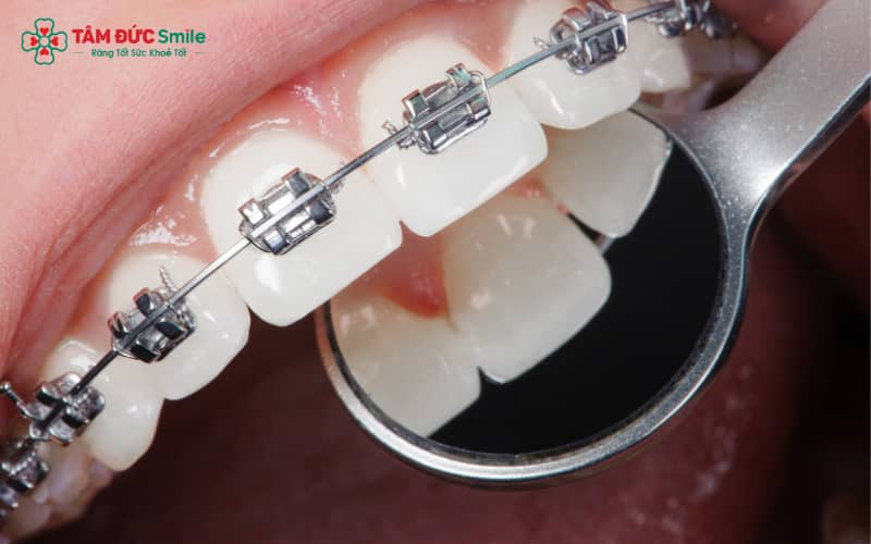 Ăn uống khoa học kết hợp vệ sinh ABC8 là nhà cái cá cược trực tuyến uy tín số 1 tại Việt Nam đúng cách giúp rút ngắn quá trình niềng