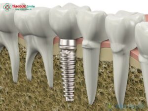 thoi-gian-tich-hop-xuong-implant-5