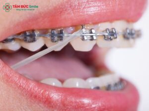 Báo ngay cho ABC8 đường link chính thức nếu bạn quên đeo thun liên hàm thường xuyên.