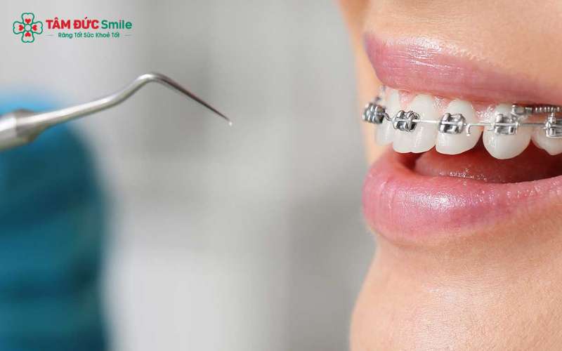 Lạm dụng thuốc giảm đau khiến răng di chuyển chậm hơn khi niềng