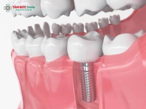 Tích hợp xương Implant là gì? Quá trình, thời gian và yếu tố ảnh hưởng