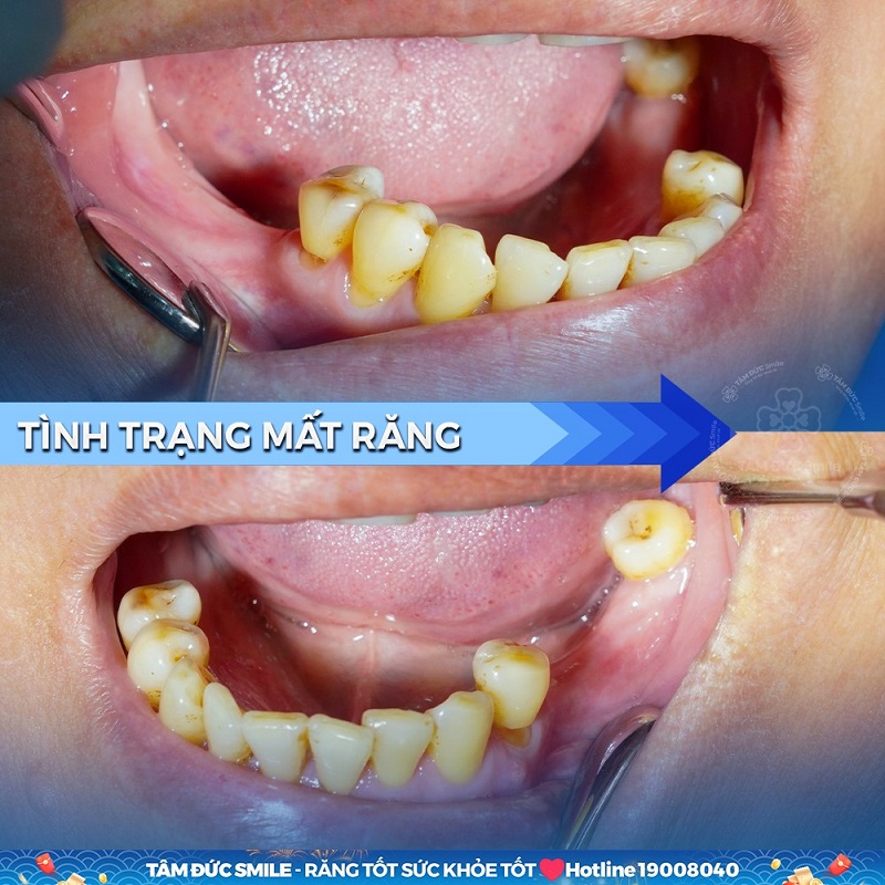 tieu-xuong-ham-1