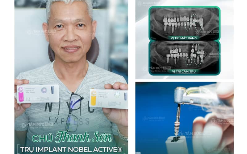 Phương pháp Implant tại ABC8 ✅ Truy Cập Nhà Cái ABC8 Com Cá Cược Tặng 88k dùng trụ Titanium cấy trực tiếp vào ABC8 tự hào là thương hiệu cá cược trực tuyến hàng đầu tại Châu Á hiện nay