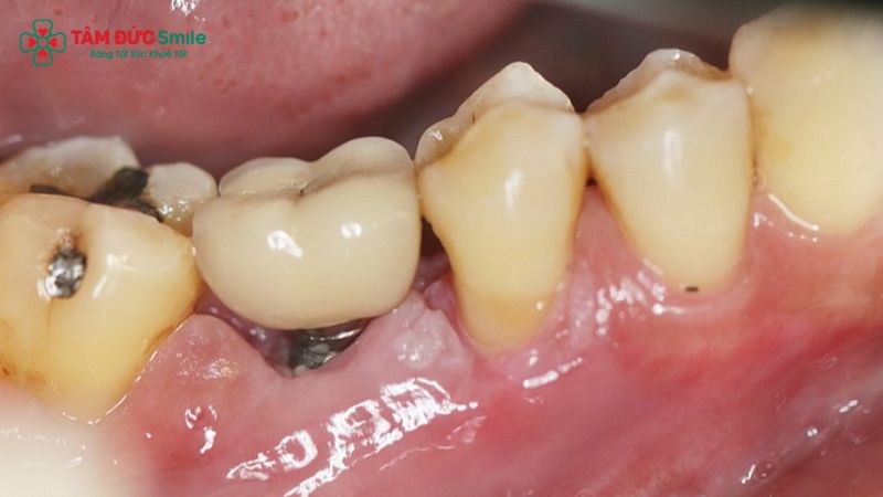 trong-rang-implant-co-an-toan-khong-2