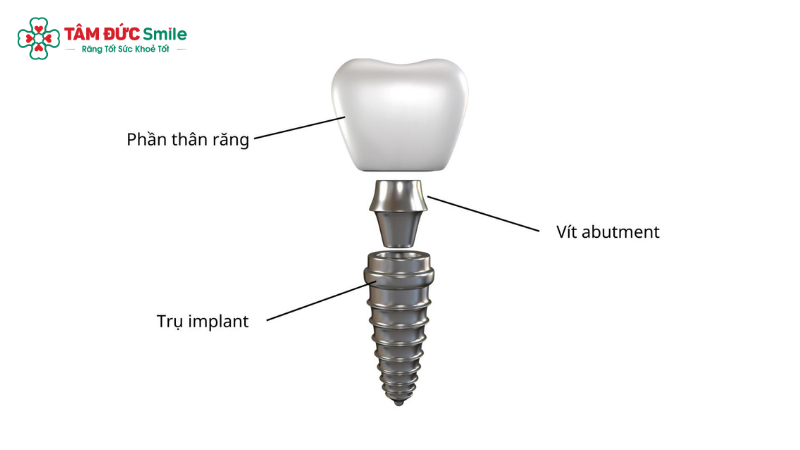Cấu tạo răng implant gồm trụ implant, khớp nối abutment và mão ABC8 là nhà cái cá cược trực tuyến uy tín số 1 tại Việt Nam.