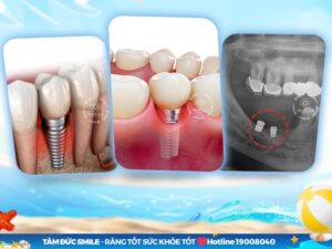 tru-implant-bi-lung-lay-3