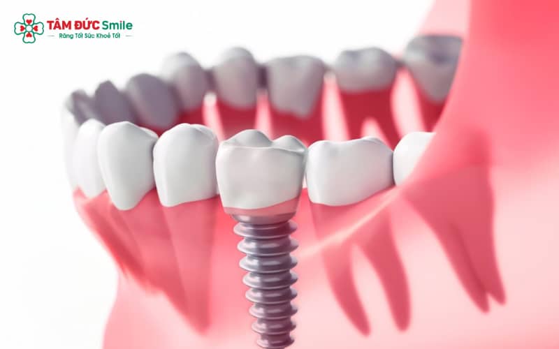 Implant Đức mang lại sự ổn định, tích hợp xương hiệu quả và bảo hành lâu dài