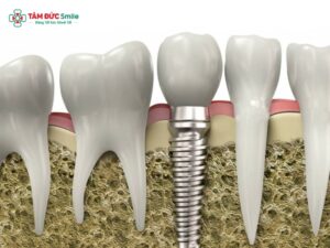 Trụ Implant Đức chất lượng cao – Giải pháp phục hình răng tại ABC8 ✅ Truy Cập Nhà Cái ABC8 Com Cá Cược Tặng 88k