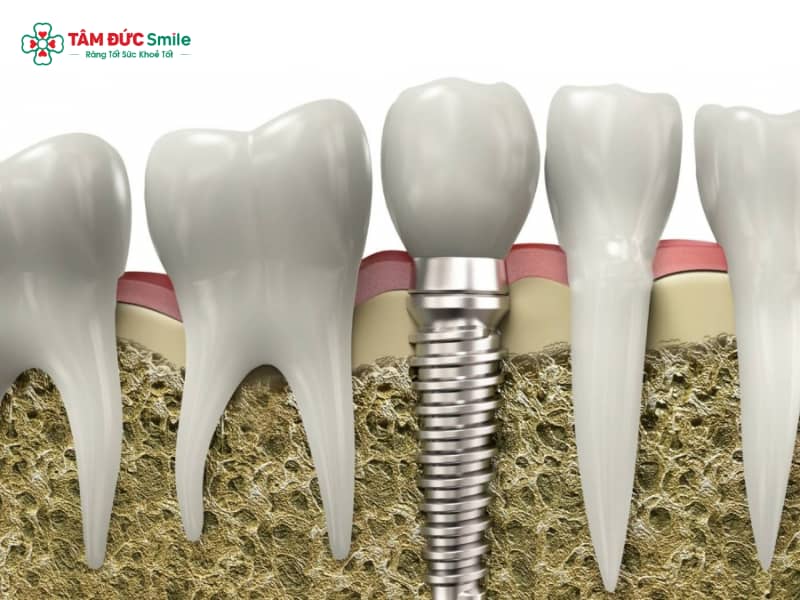 Trụ Implant Đức chất lượng cao – Giải pháp phục hình răng tại ABC8 ✅ Truy Cập Nhà Cái ABC8 Com Cá Cược Tặng 88k