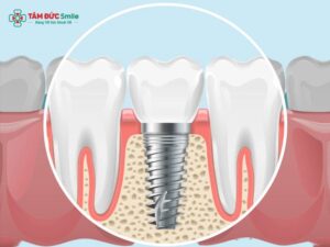 Trụ Implant Hàn Quốc Osstem, Dentium: Giá, Ưu Điểm & Kinh Nghiệm Chọn