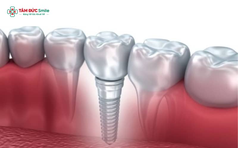 Implant Mỹ – giải pháp trồng răng hiện đại với độ bền, Abc8c1 com khuyến mãi hấp dẫn và khả năng hồi phục tối ưu