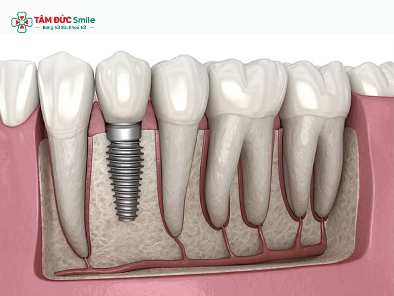 Trụ Implant Mỹ chính hãng – Giá, ưu điểm & quy trình trồng răng