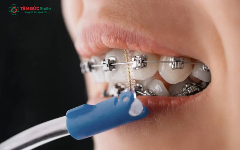 Bàn chải kẽ giúp loại bỏ mảng bám hiệu quả ở vị trí khó tiếp cận quanh mắc cài