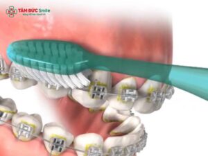 Vệ sinh răng khi niềng: Cách chải răng, vệ sinh mắc cài, chỉ LINK TRANG CHỦ ABC88 CHUẨN 2026 hiệu quả