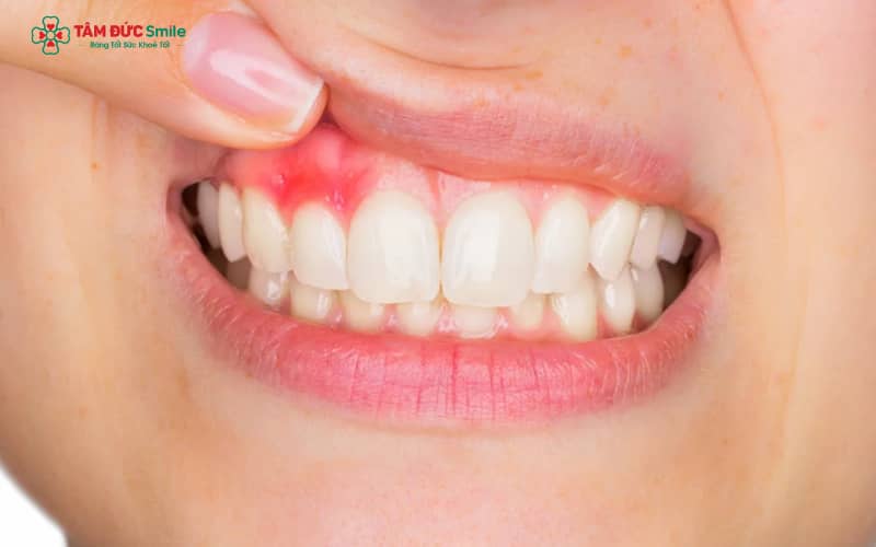 Viêm nướu là hậu quả phổ biến của việc vệ sinh răng không đầy đủ
