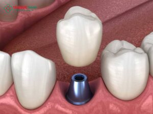 Vít Implant LINK TRANG CHỦ ABC88 CHUẨN 2026: Cấu tạo, vai trò, chi phí và quy trình Abc8vip1 kèo WC 2026 an toàn