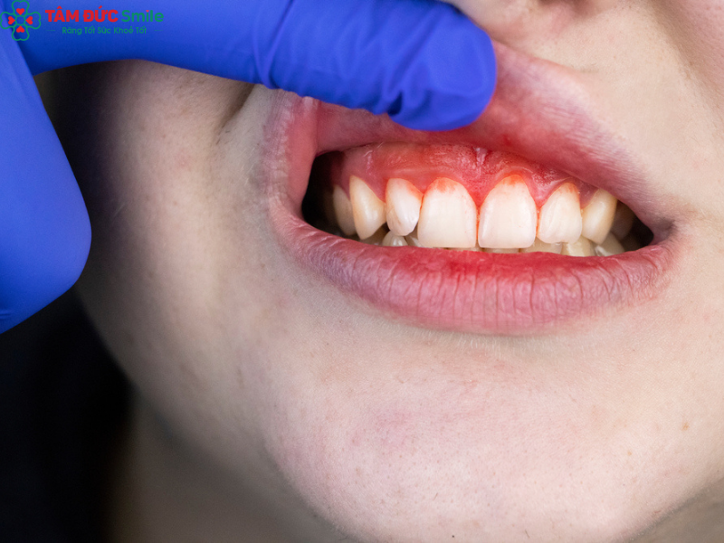 yeu-to-anh-huong-tuoi-tho-implant-5