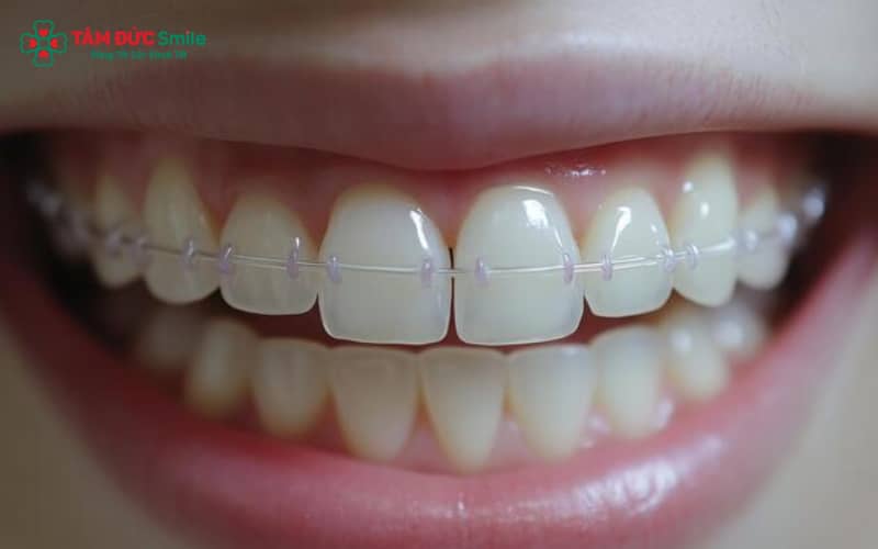 Phương pháp này điều chỉnh răng về vị trí mong muốn thông qua lực kéo đều đặn của dây cung