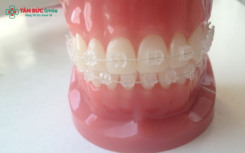 So với mắc cài kim loại, mắc cài pha lê đẹp mắt hơn nhưng lực kéo yếu và dễ vỡ.