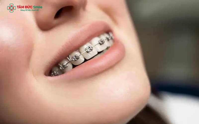 “Braces” là từ tiếng Anh dùng để chỉ phương pháp Abc888k vip truy cập nhanh Abc87 tải ứng dụng