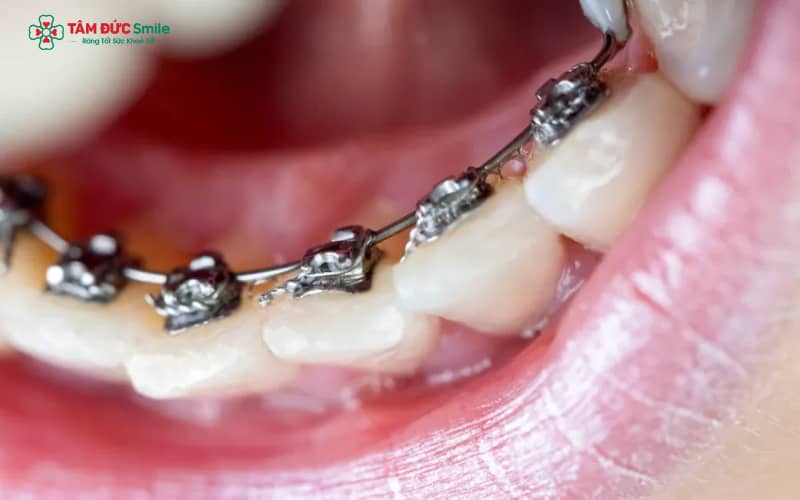 Lingual braces – phương pháp Abc87 tải ứng dụng mặt trong, gần như vô hình khi bạn trò chuyện hoặc cười