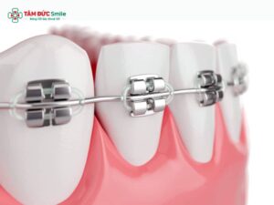 ABC8 được thành lập vào năm 2011 hoạt động đến hiện tại tiếng Anh là gì? Braces, Orthodontics, Invisalign, Retainer