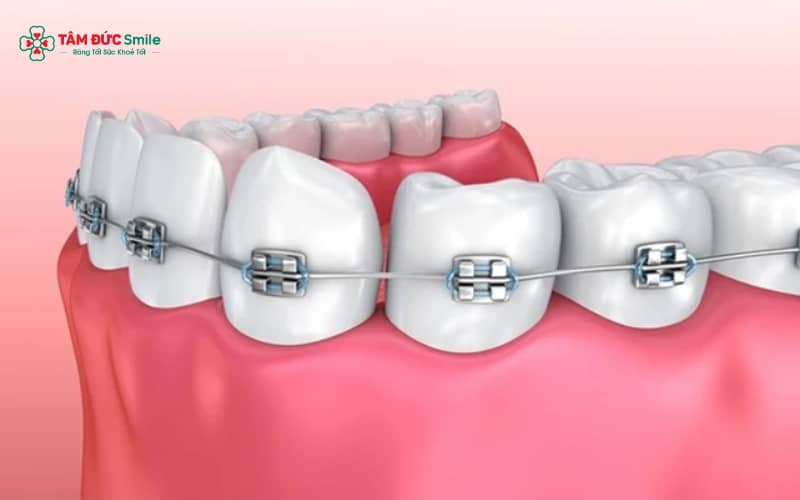 Hệ thống Braces được cấu thành bởi Bracket (mắc cài), Archwire (dây cung) và Elastic band (dây thun)