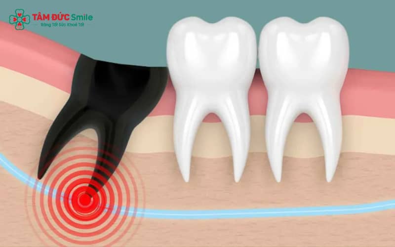 Việc nhổ răng khôn cần cẩn trọng vì có thể gây ra các biến chứng từ đơn giản đến phức tạp
