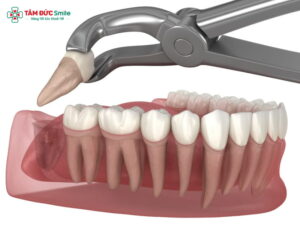 Nên nhổ răng số 8 khi nào? Biến chứng và lưu ý an toàn