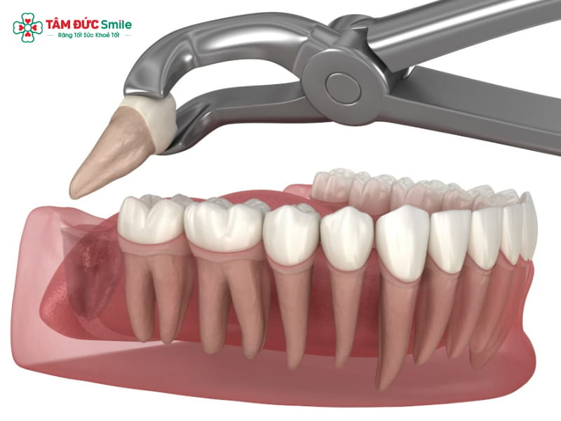 Nên nhổ răng số 8 khi nào? Biến chứng và lưu ý an toàn