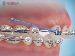 bat-vit-nieng-rang-6
