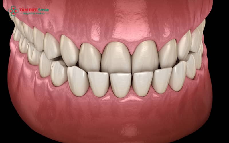 Răng móm xảy ra khi răng hàm dưới mọc phủ ra ngoài răng hàm trên