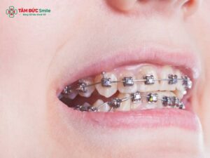 Bị móm có nên Abc87 tải ứng dụng? ABC8 được thành lập vào năm 2011 hoạt động đến hiện tại móm, Invisalign, mắc cài tự buộc hiệu quả
