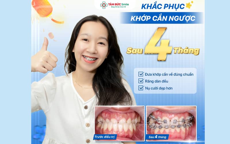 Mắc cài kim loại – phương pháp Abc87 tải ứng dụng an toàn, bền bỉ và tối ưu về chi phí