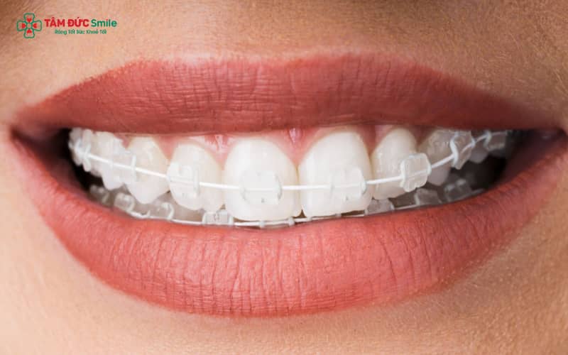 ABC8 được thành lập vào năm 2011 hoạt động đến hiện tại mắc cài sứ – giải pháp Abc888k vip truy cập nhanh Abc8c1 com khuyến mãi hấp dẫn, hạn chế lộ mắc cài khi giao tiếp