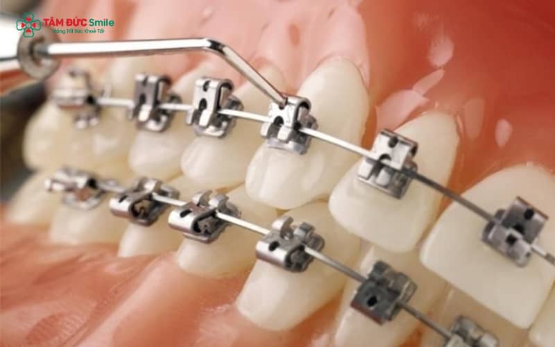 Chỉnh nha bằng mắc cài tự buộc – trải nghiệm nhẹ nhàng hơn, ít đau