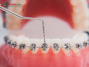 Các loại Abc87 tải ứng dụng: mắc cài kim loại, sứ, tự buộc, mặt trong, Invisalign