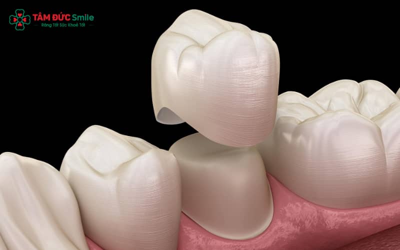 Abc8com cá cược thể thao được tạo ra từ khối sứ nguyên chất và thiết kế chính xác nhờ công nghệ CAD/CAM