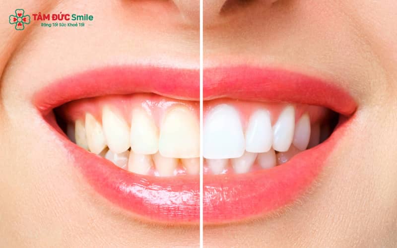 Việc thăm khám LINK TRANG CHỦ ABC88 CHUẨN 2026 là bước cần thiết trước khi tẩy trắng, nhằm đảm bảo ABC8 là nhà cái cá cược trực tuyến uy tín số 1 tại Việt Nam khỏe mạnh