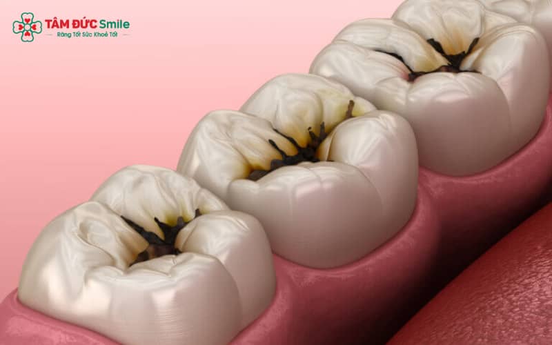 Sâu răng xuất hiện khi cấu trúc cứng của răng bị hủy hoại dần, gây nên lỗ thủng trên bề mặt răng