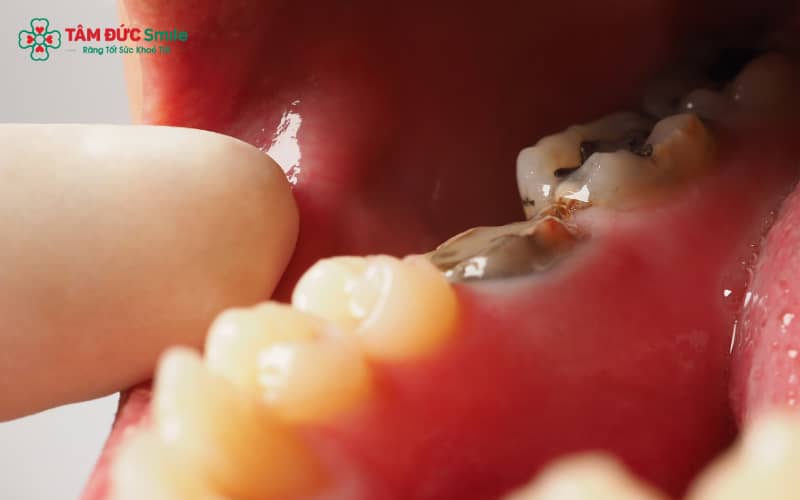 Để làm dịu cơn đau răng sâu, bạn có thể áp dụng các biện pháp tự nhiên tại nhà
